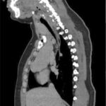 medical imaging of a thoracic region showing the heart and spine structure