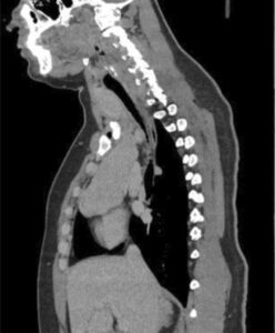 medical imaging of a thoracic region showing the heart and spine structure
